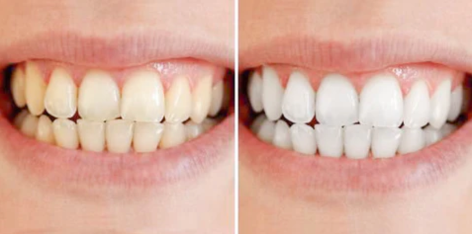 Strålende Smil™ – Klinik-inspireret tandblegning til hjemmebrug