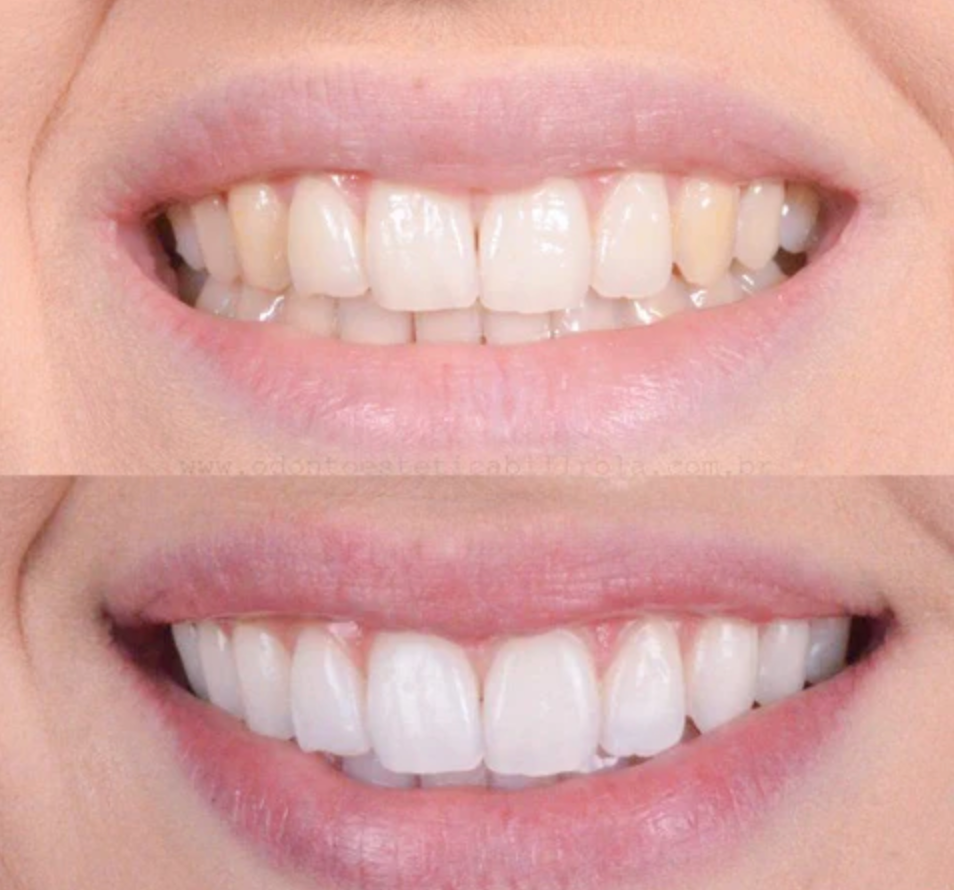 Strålende Smil™ – Klinik-inspireret tandblegning til hjemmebrug