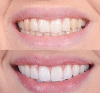 Strålende Smil™ – Klinik-inspireret tandblegning til hjemmebrug