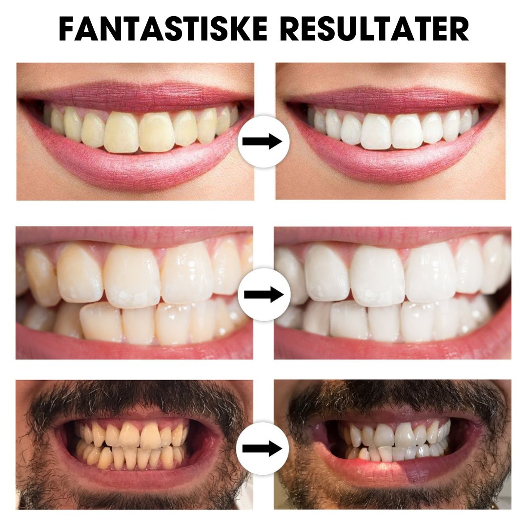 Strålende Smil™ – Klinik-inspireret tandblegning til hjemmebrug