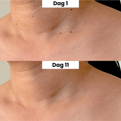 ClearSkin™ Pen – Sikker fjernelse af hudmærker!