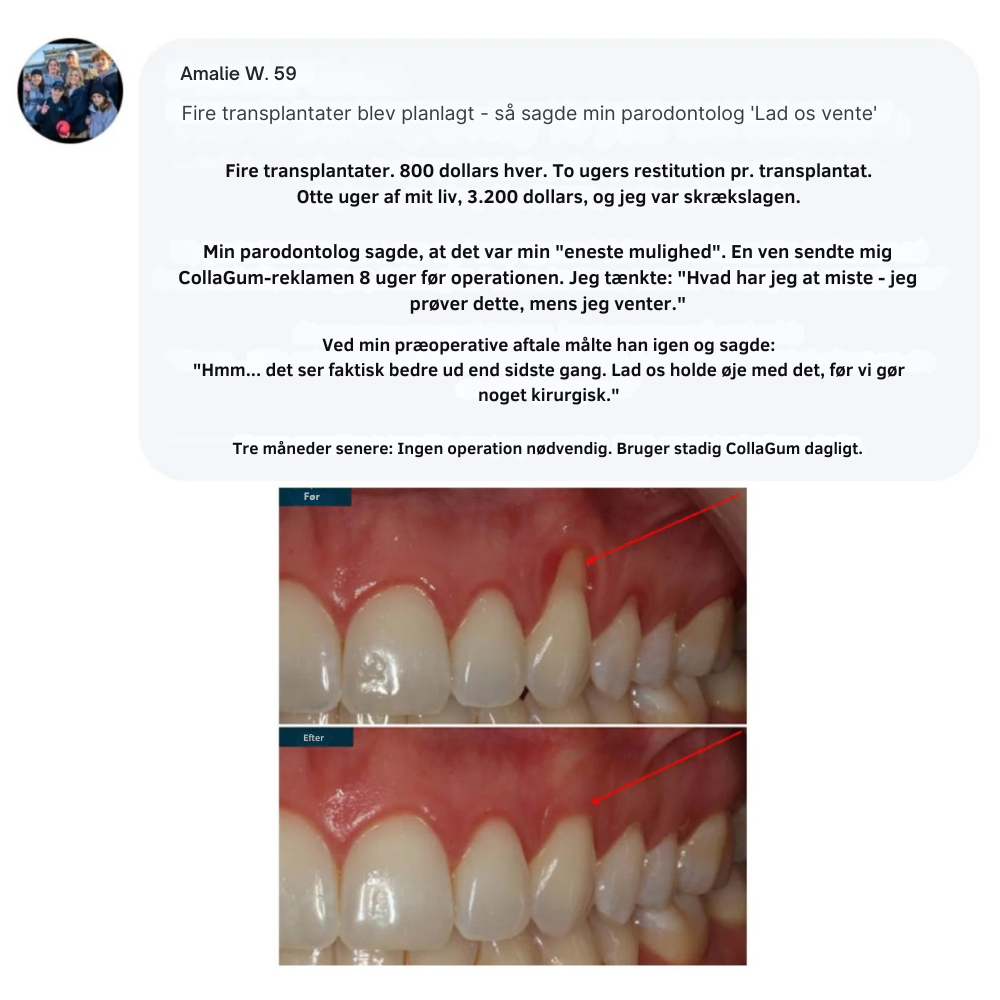 CollaGum™ | Styrk dit tandkød indefra og bevar dit naturlige smil