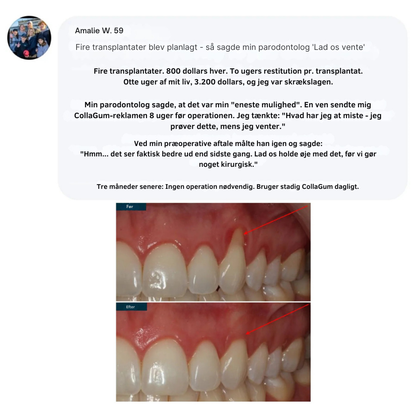 CollaGum™ | Styrk dit tandkød indefra og bevar dit naturlige smil