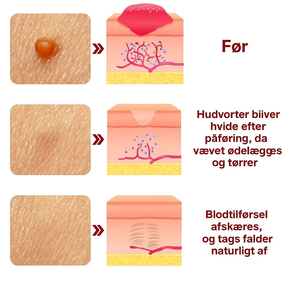 DermaCure™ | Fjerner vorter og alderspletter – smertefrit inden for 3 dage!