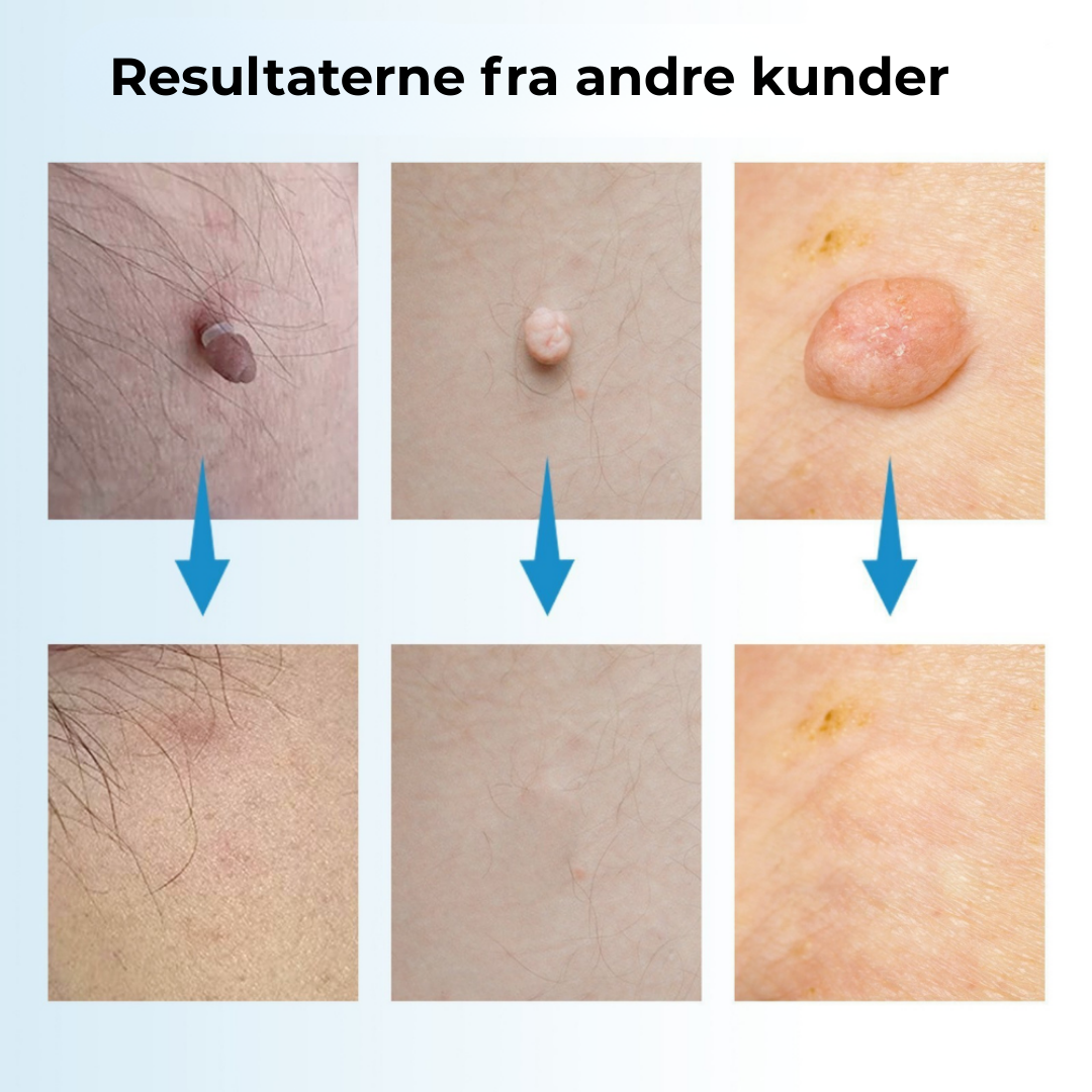 ClearSkin™ Pen – Sikker fjernelse af hudmærker!