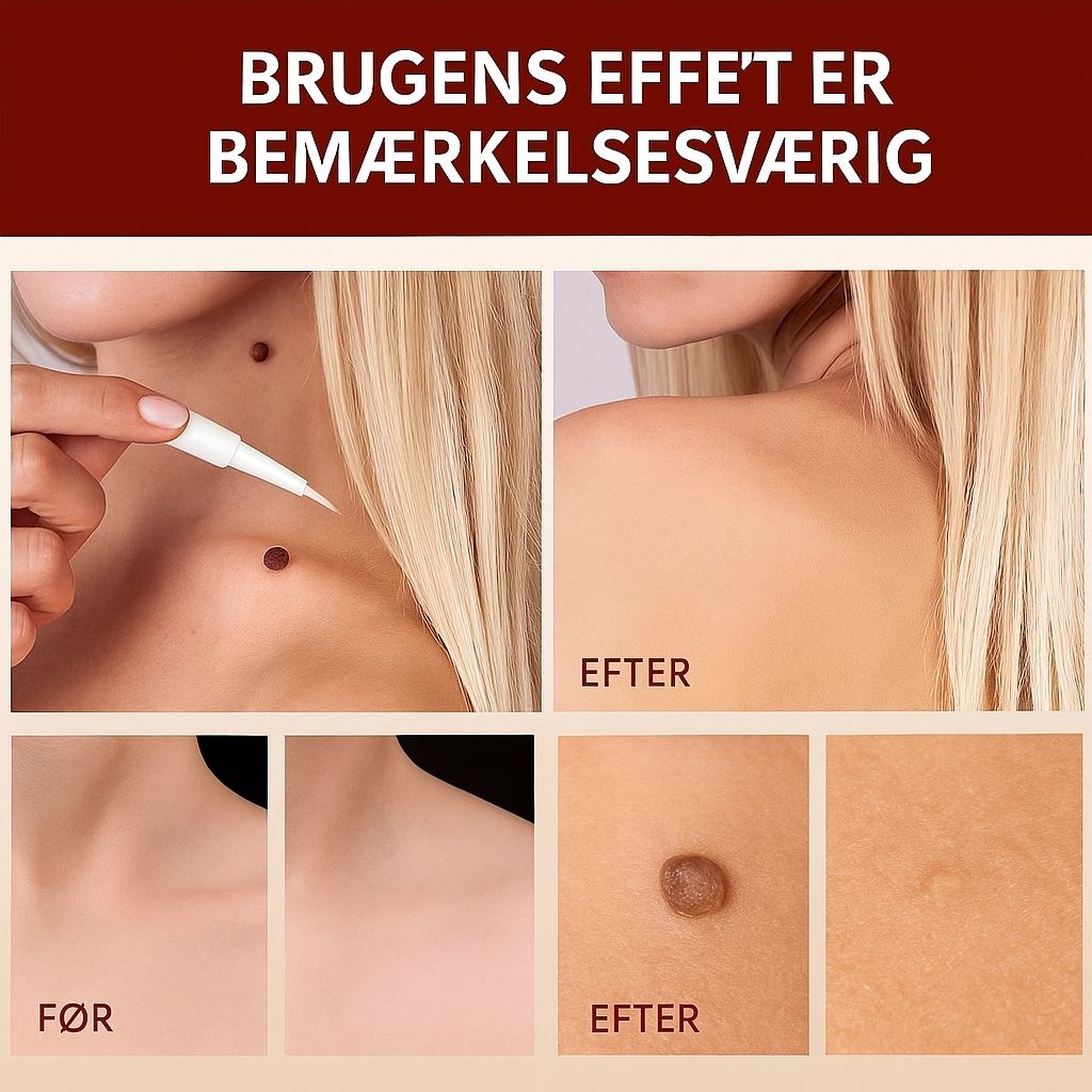 DermaCure™ | Fjerner vorter og alderspletter – smertefrit inden for 3 dage!
