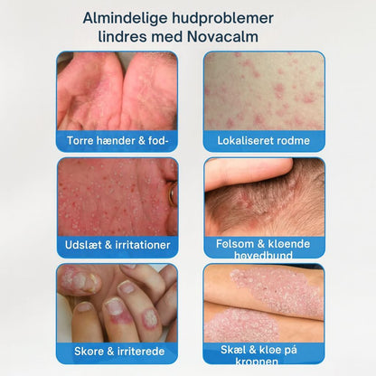 NovaCalm Advance™ – Naturlig lindring for kløende, rød og sensitiv hud