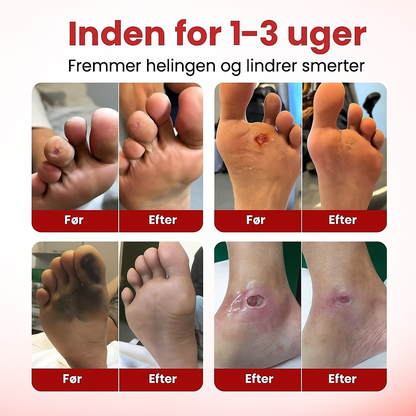 VitaGluco™ | Stop genstridige diabetiske sår og genskab sund hud på få dage