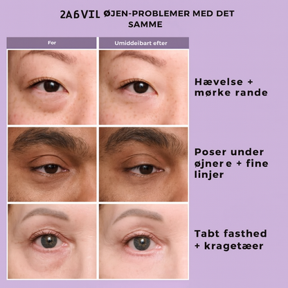Lumina Øje™ -  Øjeblikkelig løft – uden nåle