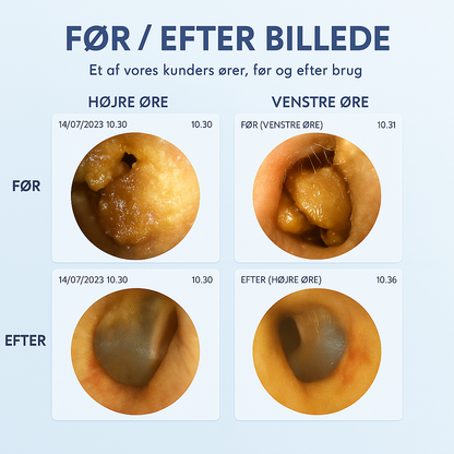 Nova WaxCleaner™ – Smart & Skånsom Ørerens med HD-Præcision