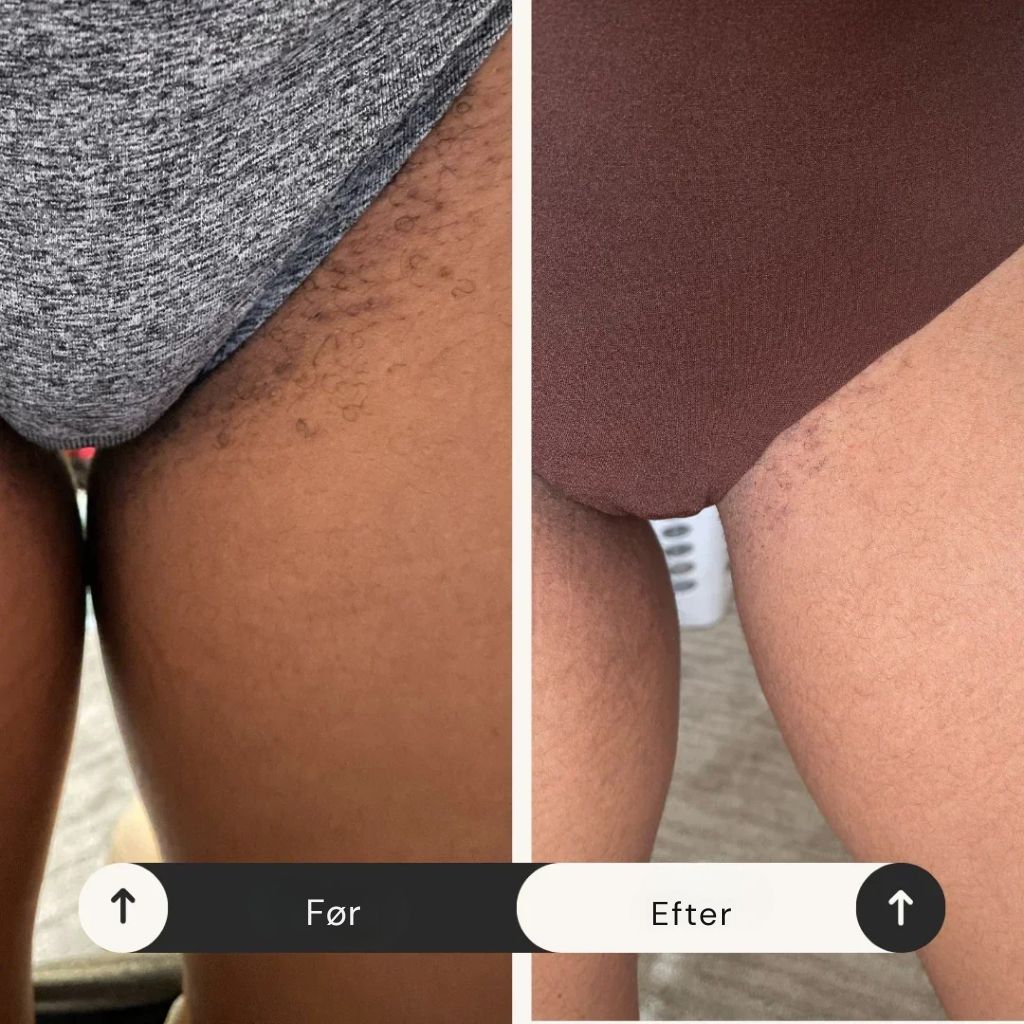 VagiSafe Care™ – Frihed fra kløe på bare 72 timer