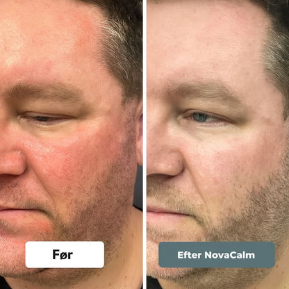 NovaCalm Advance™ – Naturlig lindring for kløende, rød og sensitiv hud