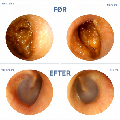 Shoppenhagen™ – Smart ørerens med avanceret teknologi