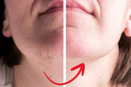 HairErase Cream™ Hormonbaseret hårfjerner... Begrænset lagerbeholdning i Sverige!