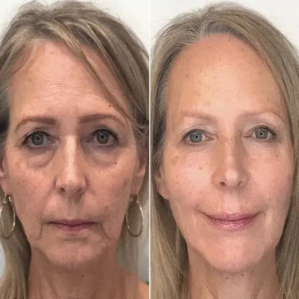 SkinLiftCare™ Botox Serum - Synligt yngre hud på 14 dage.