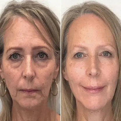 SkinLiftCare™ Botox Serum - Synligt yngre hud på 14 dage.